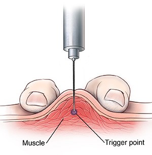 Diagram from the handout showing a needle directed into a trigger point within a muscle